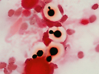 Criptococcus neoformans