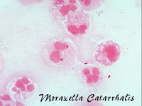 Moraxella catarrhalis