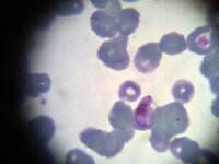 Plasmodium falciparum (gametocito)