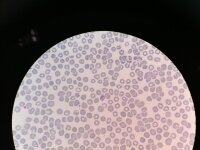 Plasmodium ovale