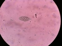 Schistosoma haematobium